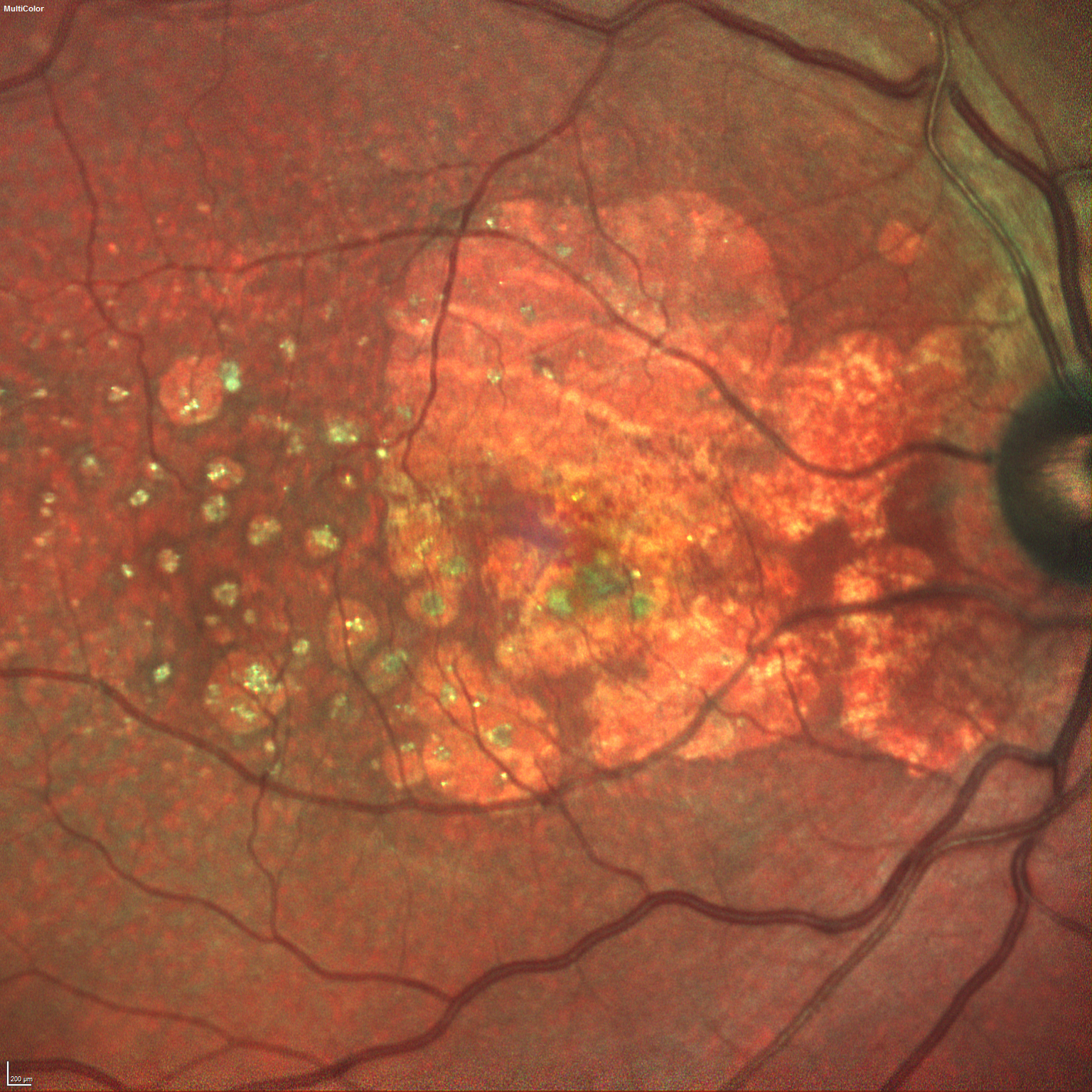 a látás elüt myopia és hyperopia látásélesség